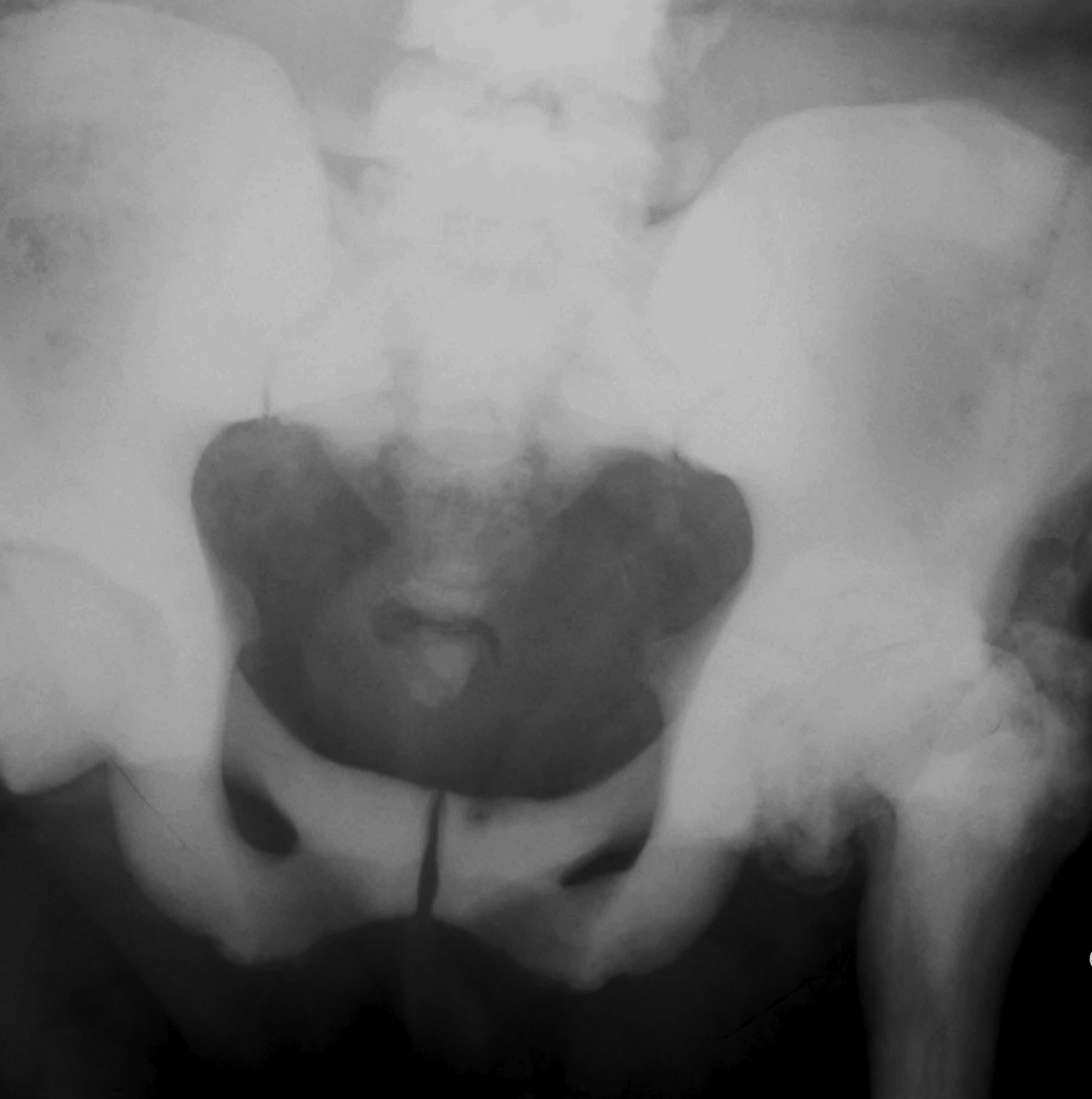 Pelvis Osteopetrosis